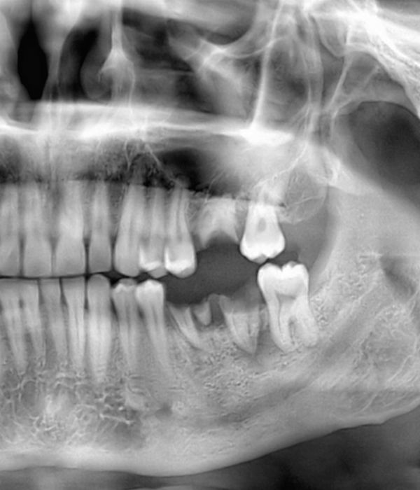 X-ray of teeth and jaw