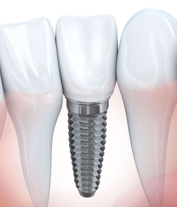 Illustration comparing dental implant to tooth roots